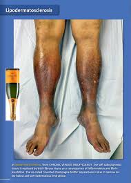 Image result for Lipodermatosclerosis