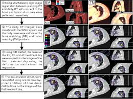 How lung cancer is treated depends on a number of factors, such as the overall health of the patient, the type of cancer, the stage of cancer and the size of cells present and whether they have. Dose Assessment For Patients With Stage I Non Small Cell Lung Cancer Receiving Passive Scattering Carbon Ion Radiotherapy Using Daily Computed Tomographic Images A Prospective Study Radiotherapy And Oncology