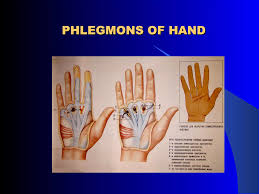 Image result for phlegmon of hand)