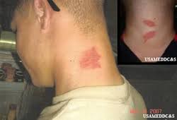 Image result for Linear Dermatitis