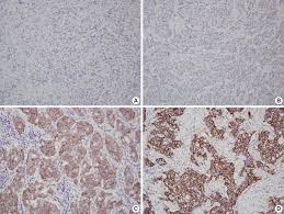 HER2 status in breast cancer: changes in guidelines and complicating  factors for interpretation