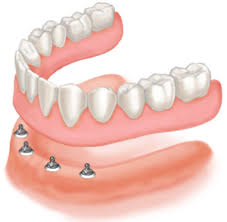 Maybe you would like to learn more about one of these? Benefits Of Implant Supported Dentures Knightsmile Dental Centre