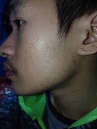 You can check out cosrx triple c lightning liquid (not recommended for sensitive skin). Vitamin A And Acne Reddit Vitaminwalls