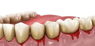 Image result for Gingivitis