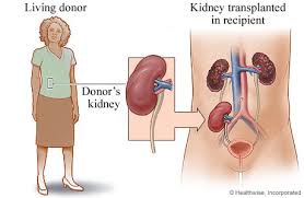 Image result for Transplantation