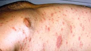 Image result for sweat rash on back