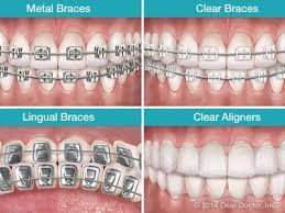 The amount of time cosmetic brackets take to straighten teeth depends on the severity of the misalignment that is being corrected, the type of cosmetic braces, and how well the patient follows the treatment plan. 50 Dental Braces Ideas Dental Braces Dental Braces