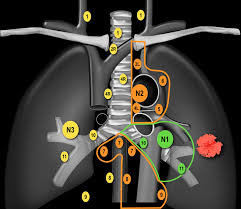 The Radiology Assistant Lung Cancer Tnm 8th Edition