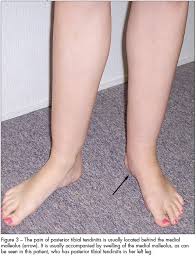 Is this normal? answered by dr. Musculoskeletal Clinics 16 Year Old Camper With Tibial Pain Consultant360