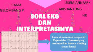 Maybe you would like to learn more about one of these? Soal Dan Cara Menginterpretasikan Ekg Part 2 Youtube