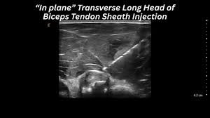 Image result for Biceps Tendon Injection