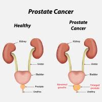 That's why it is important that patients considered high risk talk to their doctors about. Gastric Cancer Causes Symptoms And Treatment Netmeds