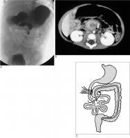 Image result for Intestinal Malrotation