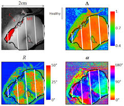 The varied discharge may mix with blood or turn into a. Osa Polarimetric Imaging Of Uterine Cervix A Case Study