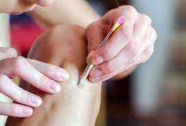 There are things you can do to treat and prevent them and ingrown hairs can look like raised, red, itchy spots on the skin. How To Get Rid Of Ingrown Hair Removal Tips Remedies