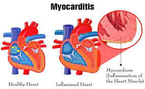 Myocarditis is an inflammatory disease of the myocardium that may present with sudden cardiac death, symptoms mimicking myocardial infarction, heart rhythm and conduction disorders, and heart failure. Myocarditis Disease With Causes Symptom And Nursing Intervention