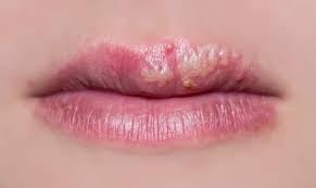 Image result for oral herpes symptoms roof of the mouth