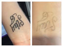 Before And After Photos Wrist 2 207 Laser Integrative Med