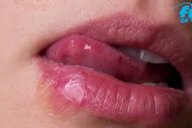 Herpes Im Urlaub Das Hilft Gegen Lippenherpes Fit For Fun