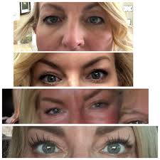 Blepharoplasty recommendations in tristate area?