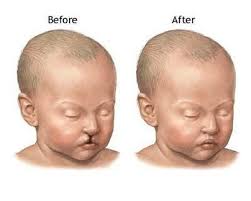 Riscul infasurarii cordonului ombilical in jurul gatului bebelusului apare atunci cand exista un cordon ombilical lung sau un exces de lichid amniotic. Infasurarea Cordonului Ombilical In Jurul Gatului Cat E De Periculoasa Copilul Ro