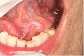 Image result for papillomavirus tongue)
