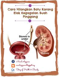 Cara merawat batu karang dalam hempedu, pundi kencing dan via www.permatacintaku.com. Cara Hilangkan Batu Karang Elak Kegagalan Buah Pinggang Story Of Health Beauty