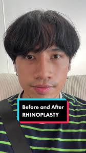 14th Day Post-Op Rhinoplasty Progress Update