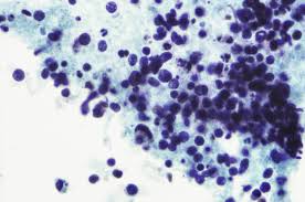 Some common symptoms of lung cancer include, according to lungcancer.com Signs And Symptoms Of Covid 19 Infection In 2 Patients With A History Of Lung Cancer Cancer Therapy Advisor
