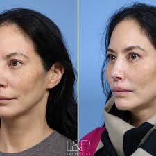 TOP 10 BEST Facial Plastic Surgeon in Sunnyvale, CA