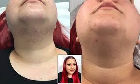 Ingrown hairs are an unfortunately common side effect of trying to remove hair. Woman With Pcos Who Started Growing Facial Hair In Her 20s Reveals Incredible Cure Daily Mail Online