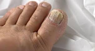 There are a number of nail changes, though, that can signal an underlying medical problem. Top 10 Reasons For Brittle And Deformed Nails Thehealthsite Com