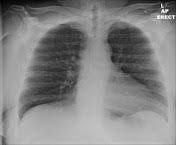 Proper usage and audio pronunciation of the word lordotic. Chest Ap Lordotic View Radiology Reference Article Radiopaedia Org