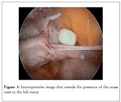 1 ﻿ there are many types of necrosis, as it can affect many areas of the body, including bone, skin, organs and other tissues. Symptomatic Encapsulated Fat Necrosis Unusual Cause Of Abdominal Pain