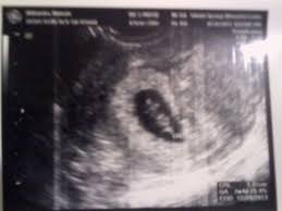 My First Ultrasound Pic 8 Weeks Ecografias Embarazo Embarazo