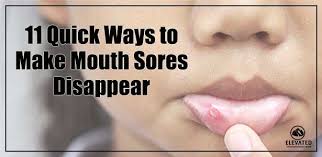 Honey is one of the best and most natural ointments for chronic mouth ulcers. 11 Quick Ways To Make Mouth Sores Disappear Elevated Dental