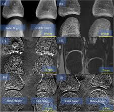 Image result for XRay Changes in Rheumatic Conditions