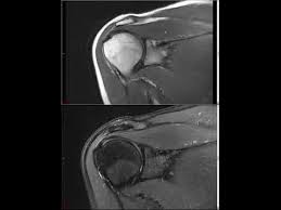 With ct or mri, it could take up to 2 hours. Shoulder Mri Approach To Msk Mri Series Youtube