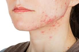 Esta Es La Causa De Los Granos En El Cuello Como Quitar Granos Remedios Para El Acne Remedios Caseros Para Granos