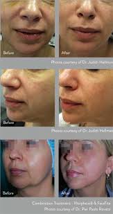 It takes about 15 minutes fir the whole face and an hour of numbing. Morpheus Face Treatment How Long Does It Last