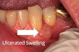 Image result for gum cancer symptoms