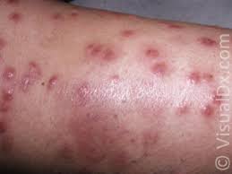 This disease is more common in males and may occur at any age from childhood onward. Make The Diagnosis Purpura Plus Pain