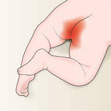 Windeldermatitis Ein Wunder Po Beim Baby Was Hilft