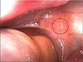 Endometriosis, disorder of the female reproductive system characterized by the growth of endometrial tissue (uterine lining) in an abnormal location. Endometriose Wikipedia