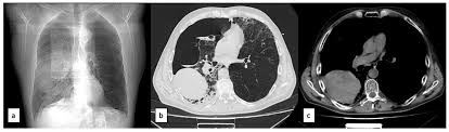 Image result for Pulmonary Contusion