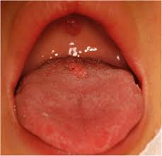 Image result for papillomavirus tongue)