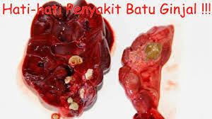 Extracorporeal shock wave lithotripsy eswl . Jual Obat Kemih Batu Batu Ginjal Tanpa Operasi Di Lapak Zahra De Nature Bukalapak