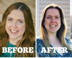 What It S Like To Recover From Double Jaw Surgery Her Heartland Soul Double Jaw Surgery Jaw Surgery Surgery