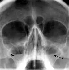 Image result for Sinus X Ray