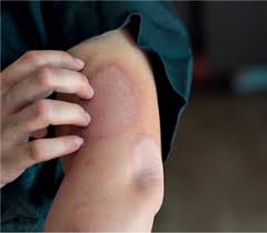 Psoriasis Spruhschaum Wirkt Rasch Pz Pharmazeutische Zeitung